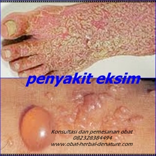 Foto Cara Mengobati Penyakit Gatal atau Eksim Dengan Obat De Nature